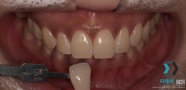 치아미백 라미네이트 잘하는 곳 찾는 2가지 기준 관련 이미지 5