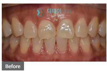 면접 전 치아미백, 꼭 알고 받으세요. 관련 이미지 4