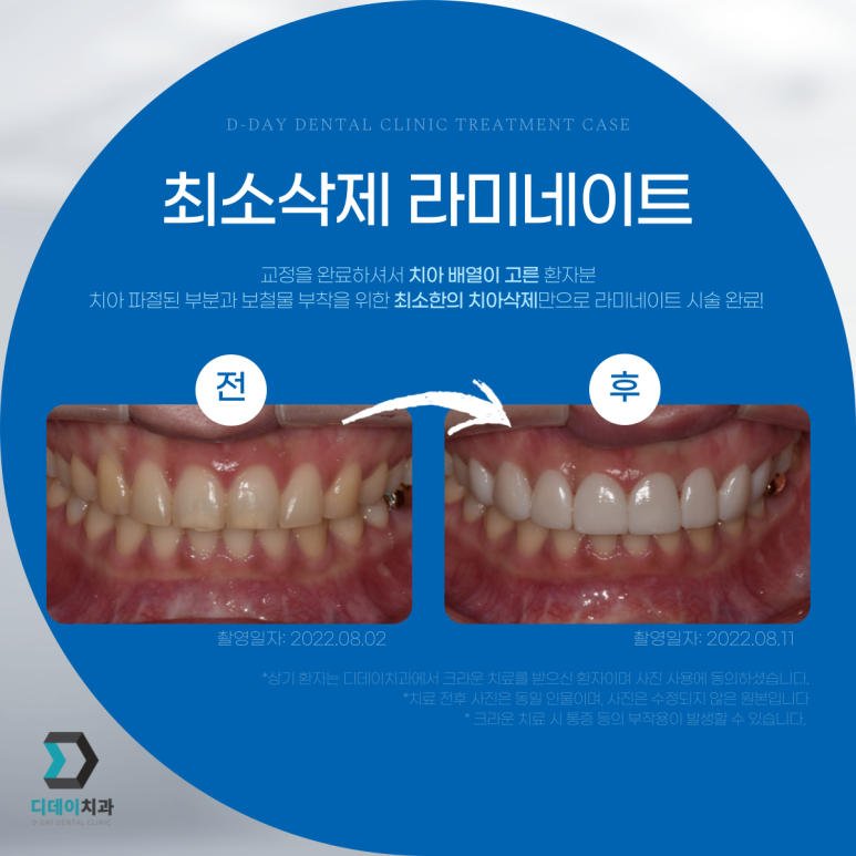최소삭제라미네이트, 누구나 다 된다고 생각하면 오산입니다. 관련 이미지 1