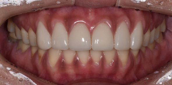 20대잇몸퇴축? 이식수술만이 답은 아닙니다. 관련 이미지 3