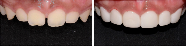 최소삭제라미네이트, 비용부터 치과 고르는 방법 관련 이미지 8