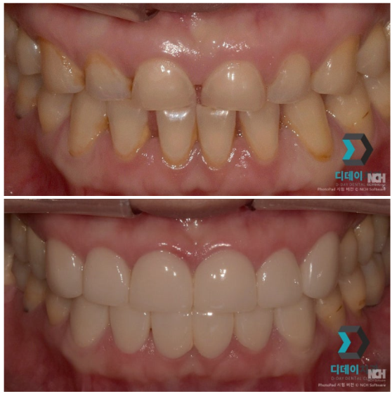 선정릉치과 라미네이트 vs 크라운, 어떤 치료가 맞을까요? 관련 이미지 5
