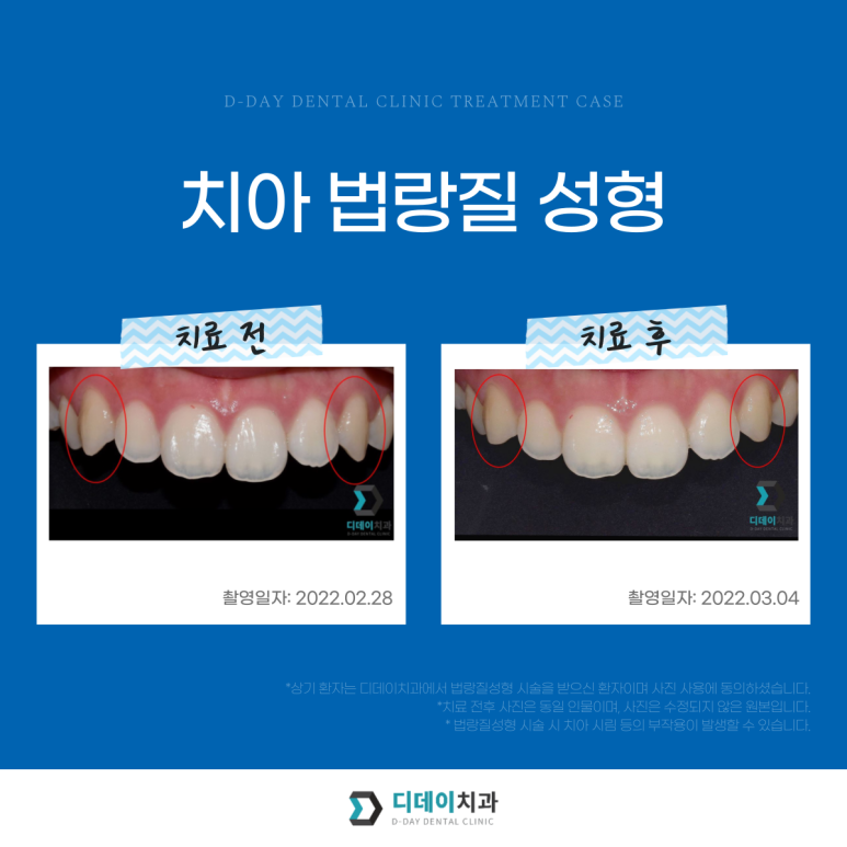 앞니성형? 라미네이트 없이 치아성형하는 방법 관련 이미지 9