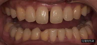 치아레진? 앞니, 치경부, 어금니 각 부위별 치료사례&비용 관련 이미지 6