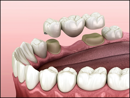 앞니브릿지가격? 치과의사가 말하는 포인트 1가지 관련 이미지 2