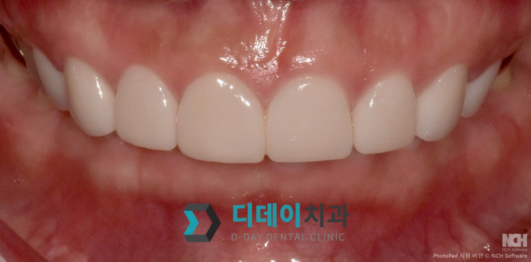 언주역치과 라미네이트 잘하는 곳? 관련 이미지 3