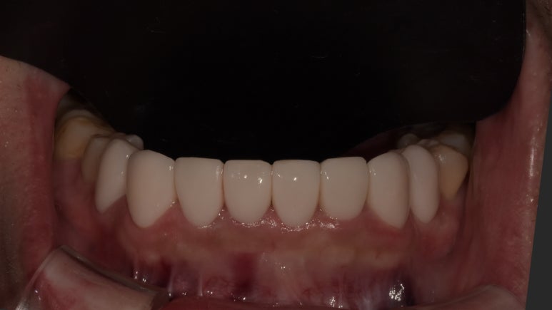 아랫니라미네이트, 잘하는 치과 찾는 2가지 기준 의사 작성 관련 이미지 6