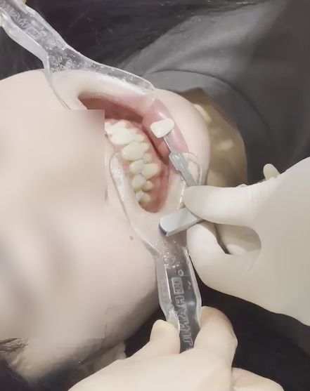 선릉역치아미백후기 보기 전에 관련 이미지 9