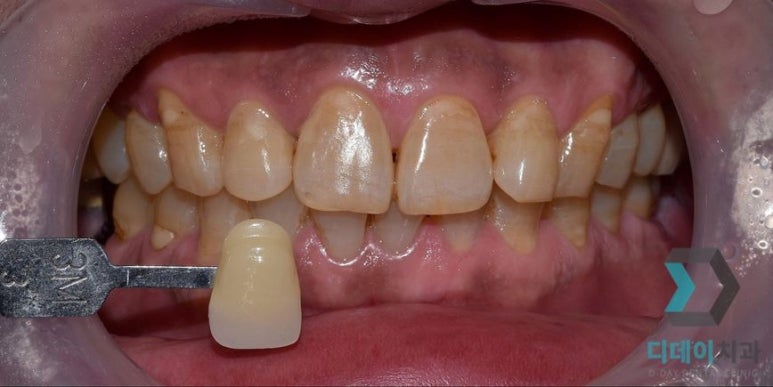 강남치아미백, 금세 또 착색되는 이유와 원데이 치료사례 관련 이미지 6