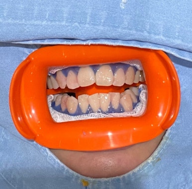 미백치약효과, 진짜 있을까? 치과의사가 전부 설명드립니다. 관련 이미지 3