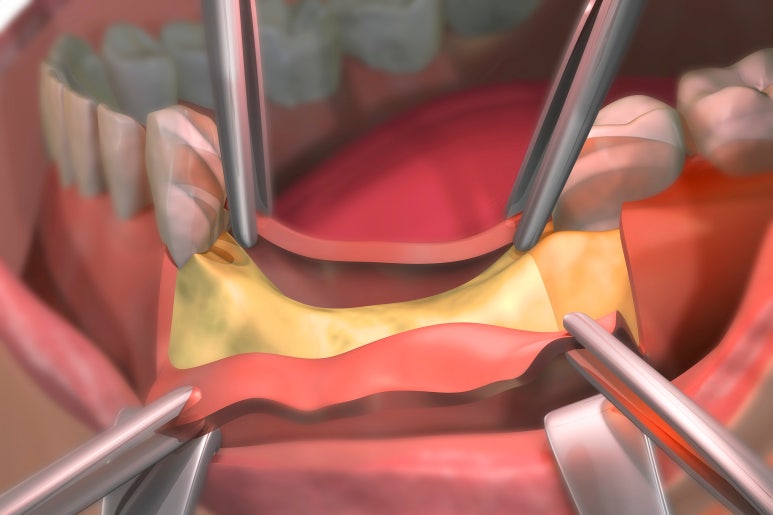 임플란트상악동거상술, 통증은 OO 때문이다? 관련 이미지 2