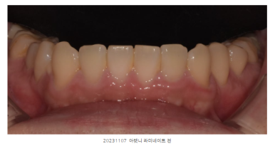 라미네이트유지기간, 절반도 못 쓰고 후회하는 환자들의 공통점 관련 이미지 3