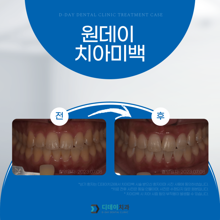 웨딩촬영치아미백? 자신있게, 환하게 웃을 수 있는 꿀팁 관련 이미지 11