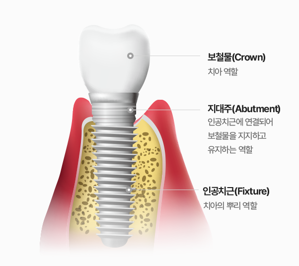 임플란트보증기간, 이 글로 정리해드립니다. 관련 이미지 2