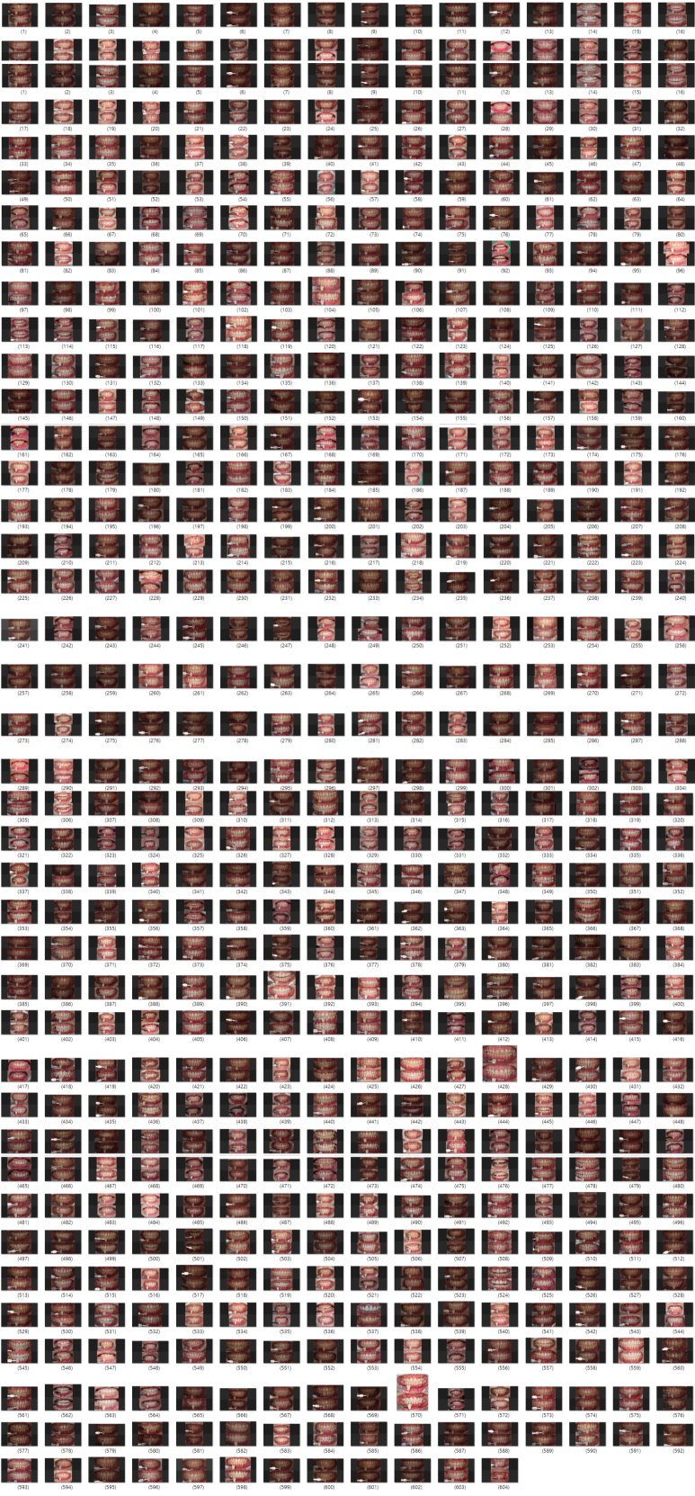 치과치아미백, 700명 이상이 디데이치과를 선택한 이유? 관련 이미지 1