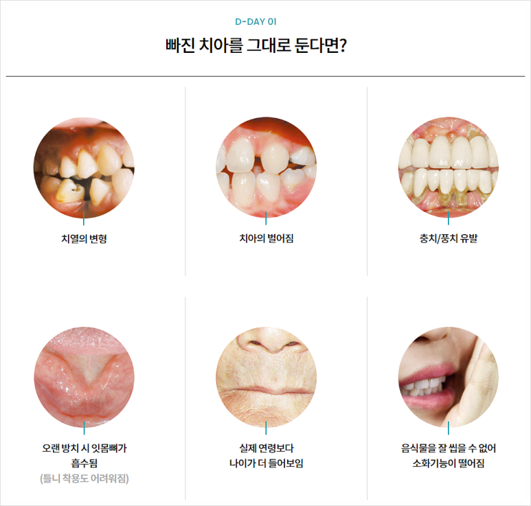 국산임플란트를 선택한 이유, 치료사례 공개합니다 관련 이미지 10