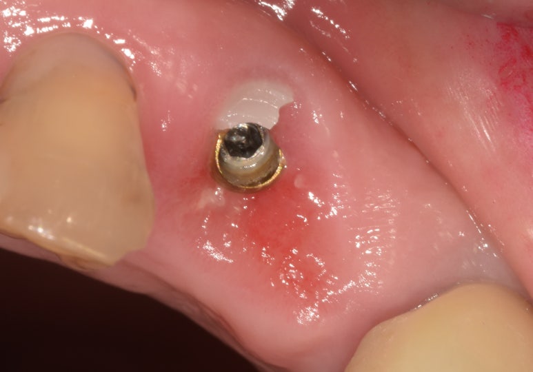 임플란트깨짐, 단순한 문제가 아닐 수 있습니다. 관련 이미지 5