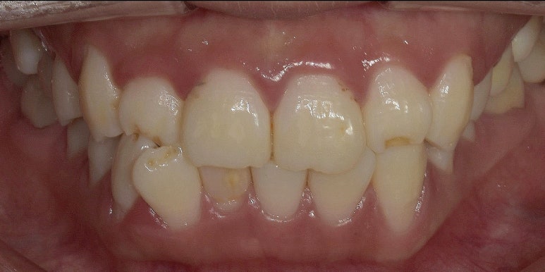 교정없이 라미네이트로 치아배열 개선? 앞니 12개 케이스 공개 관련 이미지 2