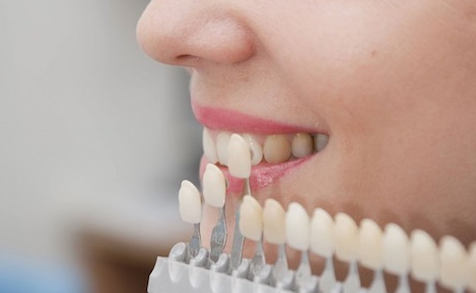 서초동라미네이트, 잘하는 치과특징 3가지 정리했습니다 관련 이미지 2