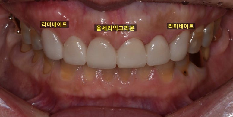 라미네이트올세라믹, 차이점과 치료사례까지 모두 공유합니다. 관련 이미지 6