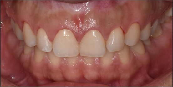 잇몸성형 비용, 통증, 회복기간, 후기까지 총정리 관련 이미지 7