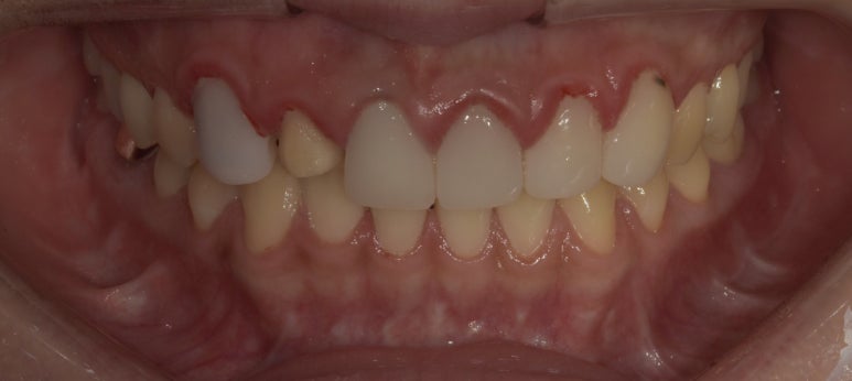 라미네이트떨어짐, 탈락 시 재부착 가능할까요? 관련 이미지 2