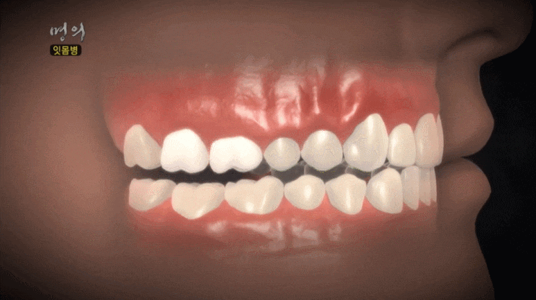 치은절제술/성형술? 잇몸이 치아를 덮고 있어 고민인 분만 관련 이미지 1