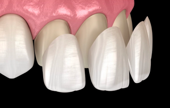 치아미백 vs 라미네이트, 누렁니 탈출하고 싶으신 분들만 관련 이미지 6