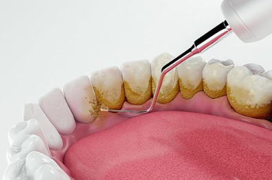 Apgujeong Rodeo Station Dental Clinic: If Your Gums Bleed, Never Ignore It image 3