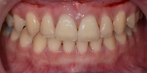 법랑질성형, 앞니 치아모양이 고민이라면 관련 이미지 6