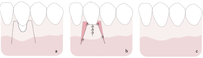 근단변위판막술, 이 글 하나로 궁금증 해결하세요 관련 이미지 6