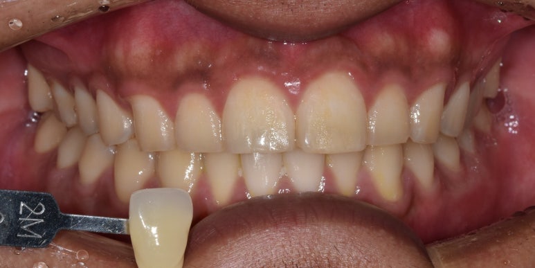 누렁니치아미백, 치료 사례로 보여드리는 개선 효과 관련 이미지 5