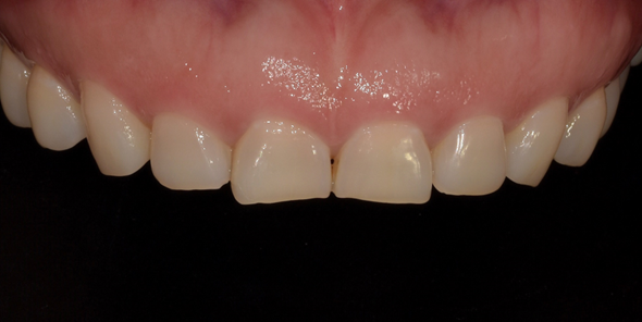 잇몸성형유지기간? 치과의사가 직접 알려드립니다. 관련 이미지 5