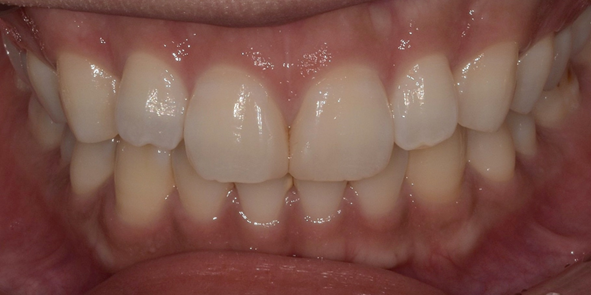 라미네이트, 치아보험 적용이 가능할까요? 관련 이미지 7