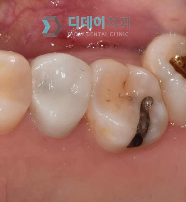 치과레진가격, 진솔하게 공개합니다. (+좋은치과 찾는 팁) 관련 이미지 5