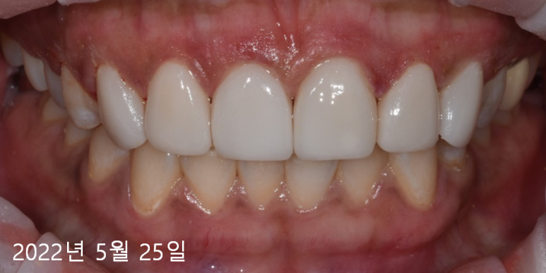 잇몸이 까매요.. 잇몸미백치료 사례 공개합니다 관련 이미지 2