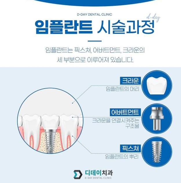 덴티움임플란트가격? 이 글로 종결합니다. 관련 이미지 3