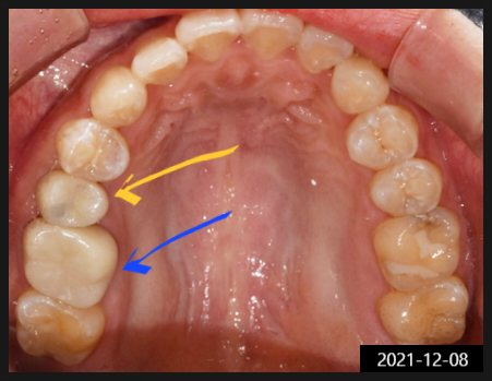 선정릉역치과, 합리적인 비용? 의사가 알려드립니다 관련 이미지 8