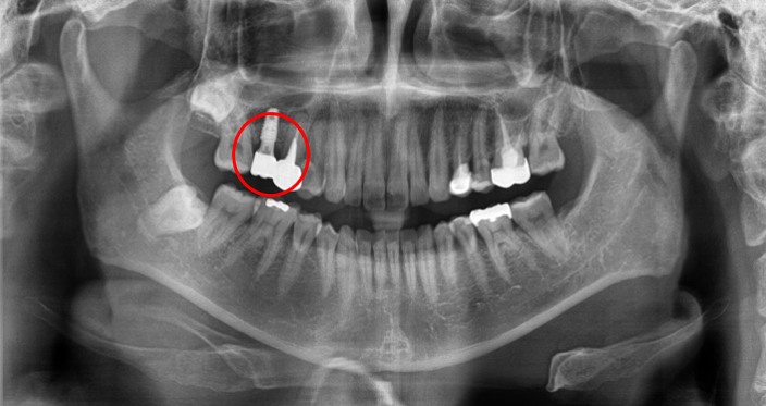 청담역치과? "뼈이식 없이" 임플란트 진행 사례 관련 이미지 4
