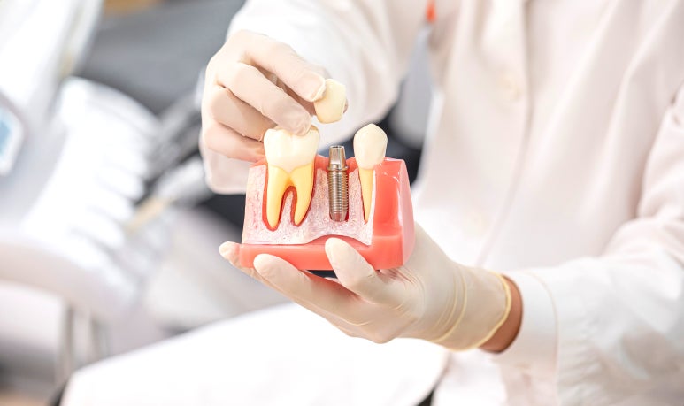 임플란트 영구적으로 사용할 수 있을지 궁금한 분만 <필독> 관련 이미지 5