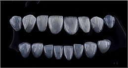 라미네이트시림, 걱정 없이 제대로 치료받는 방법? 관련 이미지 5