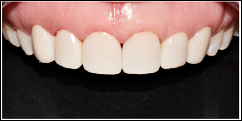 옥니라미네이트, 치과 전문의가 알려드릴께요. 관련 이미지 2