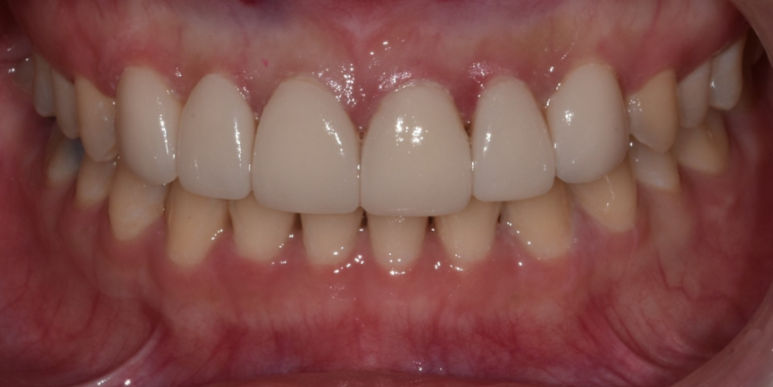 라미네이트 전후 비교, 주의사항, 비용까지 총정리 관련 이미지 16