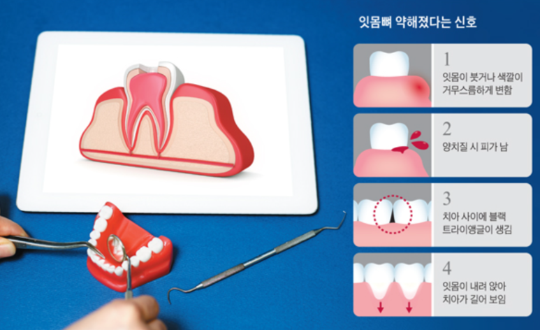 검은색치석 방치하면 위험한 이유? 필독! 관련 이미지 6