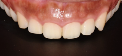 잇몸착색? 실제 치료 사례 보여드립니다. 관련 이미지 1