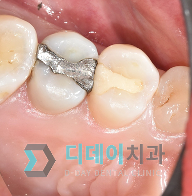 직장인구강검진으로 조기에 충치치료한 사례 공유 관련 이미지 8