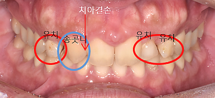 앞이빨임플란트, 내 치아처럼 감쪽같으려면? 관련 이미지 2