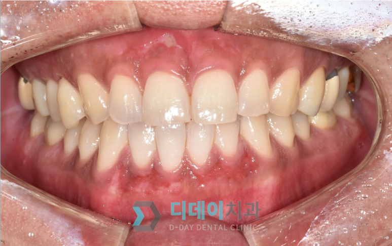 잇몸이 까매요.. 잇몸미백치료 사례 공개합니다 관련 이미지 6