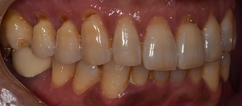 치경부마모증, 이 시린 원인과 증상부터 치료비용까지 관련 이미지 3