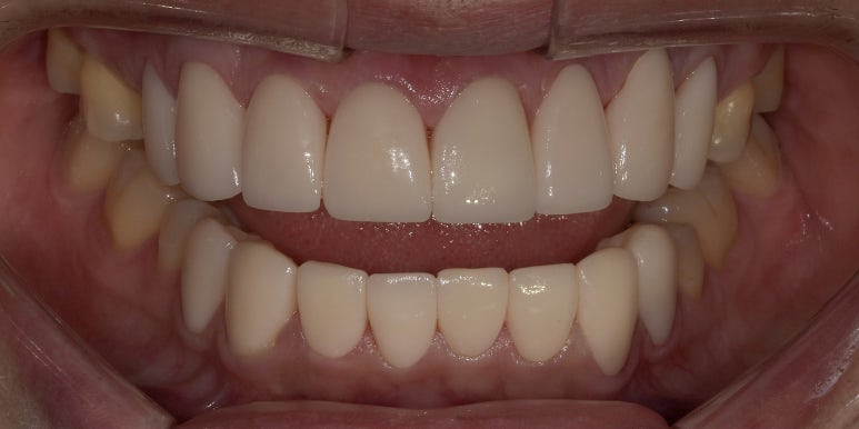 앞니라미네이트가격, 이 글 보시면 손해볼 일 없습니다. 관련 이미지 3